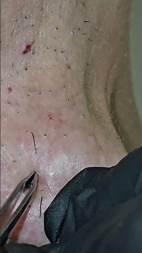 Deep Ingrown Hair Tweezing from Neck 😳 You Won’t Look Away!