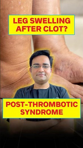 Chronic DVT Explained: Old Blood Clots & Post-Thrombotic Syndrome | Dr. Anadi Gupta