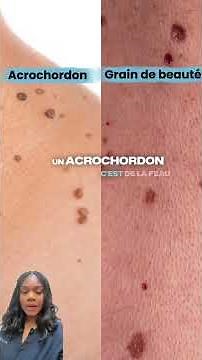 Les acrochordons, aussi appelés molluscum pendulum, sont des excroissances cutanées bénignes