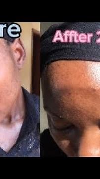 How to use rosewater and cloves on face for glowing skin#naturalremedy #rosewaterforface#rosewater