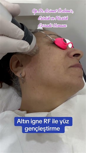 #gold needle RF application #skincare #face rejuvenation #nişantaşı