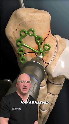 Best Fix For Most Painful Type of Bone Fracture⁉️