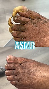 Dr. Jared Shipp • Podiatry on Instagram: "Let the snips do the talking… 🔊🦶🏼 FULL VIDEO ON OUR YOUTUBE CHANNEL‼️ . . . #houston #podologo #asmr #podiatry #texas #pedicure #satisfying #medicalpedicure #medipedi"