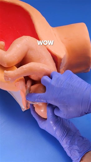 A Complex Delivery Maneuver: Navigating a Nuchal Cord 🩺