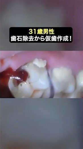 ボロボロ虫歯も6回で治療終了‼️初回の治療で仮歯も入る🦷✨#ザホワイトデンタルクリニック #歯医者 #歯石除去 #虫歯