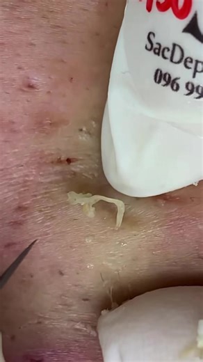 Relaxing Pimple Pops #blackhead #pimple #squeeze #skincare #asmr | blackhead