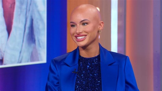 TikTok star Chloe Bean talks alopecia journey