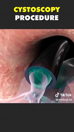 Understanding the Cystoscopy Procedure: 3D Animation Guide
