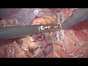 Laparoscopic Splenectomy using only three ports. Splenic Tumor. Dr Dhaval Mangukiya Gastrosurgeon