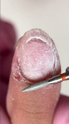 From Damaged to Healthy: The Ultimate Nail Matrix Reset 💅✨
