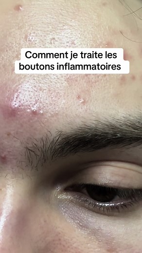 Comment traiter les boutons inflammatoires efficacement