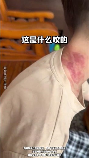 这是什么咬的？不同虫子叮咬皮肤的表现 #隐翅虫 #皮肤健康 #除螨 #抖出健康知识宝藏 #健康科普有真知