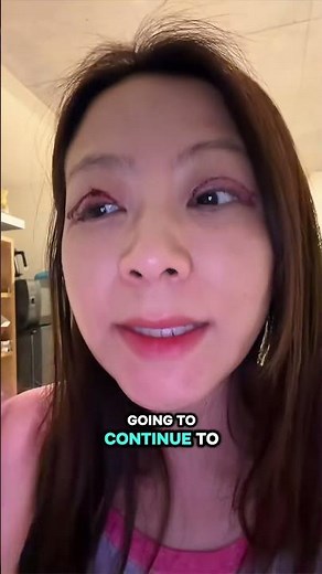 For anybody thinking about getting ptosis eye surgery. This is what it’s looking like so far