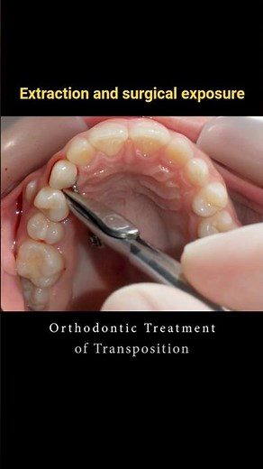 Braces can change your smile - Transposition and Impacted canine #braces #orthodontist #dentist