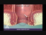 Fistula in Ano - 3D Medical Animation • Video • MEDtube.net