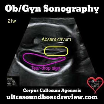 Corpus Callosum Agenesis