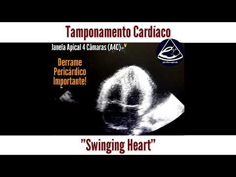 [Casos de ECO] Tamponamento Cardíaco por Derrame Pericárdico Importante com Swinging Heart
