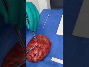 Must Watch! Third Implant Removal: EN BLOC The Gold Standard