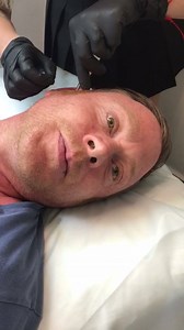 Stretching a daith as migraines started to come back after 9 months - phase 2 for Gary | Daith Piercing For Migraine