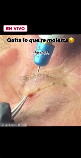 Después de eliminar un acrocordon con plasma pen, sigue estos cuidados: 1. **Mantén el área limpia**: Lava suavemente con agua y jabón neutro. 2. **Aplica crema antibiótica hasta cicatrizar (blastoestimulina o mupirosina): Usa una pomada recomendada cicatrizante (cicaplast) 3. **Evita tocar**: No rasques ni toques la zona tratada. 4. **Protégete del sol**: Usa protector solar para evitar hiperpigmentación. 5. **No mojes**: Evita sumergir en agua (piscinas, baños) durante unos días. 6. **Sigue la