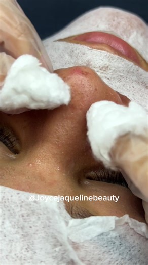 Tá na hora 😴 #satisfyingvideo #fy #poppingpimples #limpezadepele #foryoupage