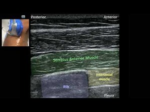 Serratus anterior plane block - rib fracture analgesia