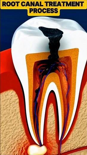 Root Canal Treatment & Tooth Abscess | 3D Dental Animation