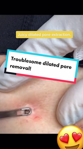 Dilated pore extraction. #extractions #whiteheadremoval #blackheadsremoval #pimplepopping #earwax