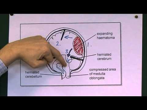 Head Injuries 9, Tentorial herniation
