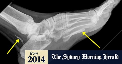 African parasitic worm found in man's foot