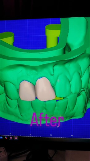 #dental #design #education #cadcam #exocad #dental design #trending #shorts