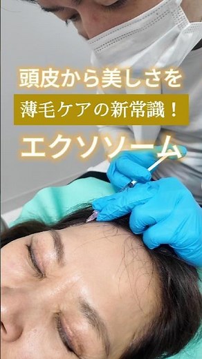 髪から美しさを育む✨薄毛ケアの新常識！頭皮エクソソーム #エクソソーム #aga