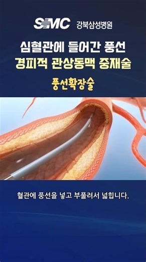 돌연사의 주요 원인인 관상동맥 질환을 고치는 경피적 관상동맥 중재술?