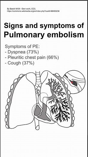 Signs and symptoms of Pulmonary embolism
