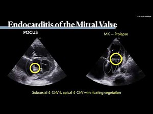 〖Echocardiography〗 Mitral valve endocarditis 🫀