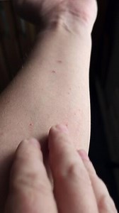 scratching itchy mild allergic rash on inner side of the arm of Caucasian male