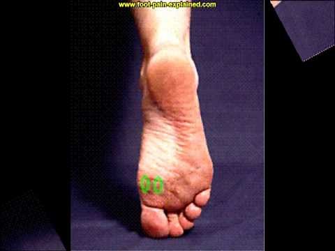 sesamoiditis treatment