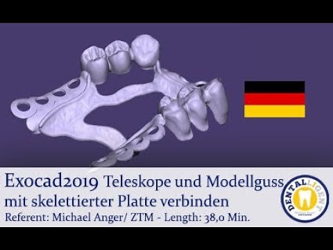 exocad2019 Tutorial Vorschau: Teleskope und Modellguss mit skelettierter Platte verbinden