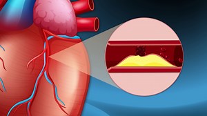 Understanding Heart Attack: Visual Animation Stock Footage SBV-352540814 - Storyblocks