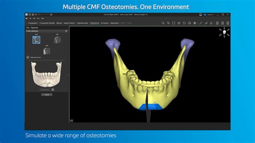 From simulating osteotomies to combining cuts on demand, Mimics Enlight CMF’s planning tools are designed with surgical teams in mind. Whether you’re working on orthognathic, trauma, or reconstruction cases, this software helps you plan more efficiently in a single, streamlined environment. Learn more about the tools that can help you make a difference: https://mtls.am/4rq3jS6 | Materialise