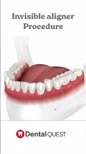 Crooked Teeth? Fix Them with Invisible Aligners | Perfect Smile Solution | Dental Quest #dentalcare