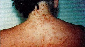 “200 stings or more.” Have you had sea lice after visiting a SC beach? Here’s what to know