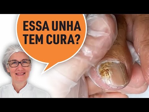 Is there a cure for a very old toenail fungus?