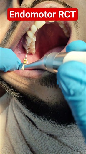 # Endomotor # Root Canal Treatment by Protaper # RCT by Rotary Instrument