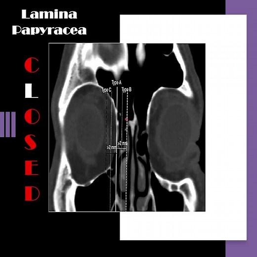 Nose radiology series (6): The lamina papyracea (2) #shorts