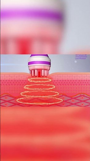 RF Body Contouring: Burn Fat & Tighten Skin Instantly!