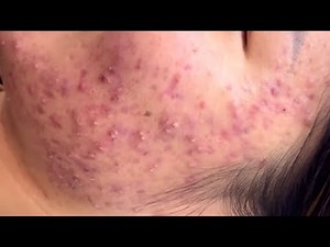 Blackhead removal | Blackheads new this week | Acne Treatment with Nasa Spa #163