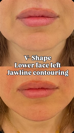 Zen Afif on Instagram: "Lower face contouring can change everything. In this case, we reshaped the jawline and restored a V-face by lifting sagging areas and redefining the mandibular line using advanced filler techniques. This is not about adding volume — it’s about structure, balance, and attraction. ✨ Jawline contouring ✨ Lower face lifting without surgery ✨ Natural V-shape restoration ✨ Age-smart aesthetic approach Saving faces, not changing them. #JawlineContouring #VFace #LowerFaceLifting 