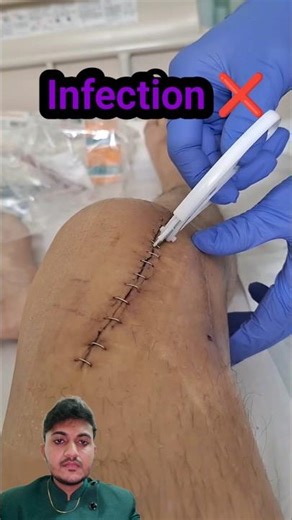 skin staple #skinstaple #stitching #wound
