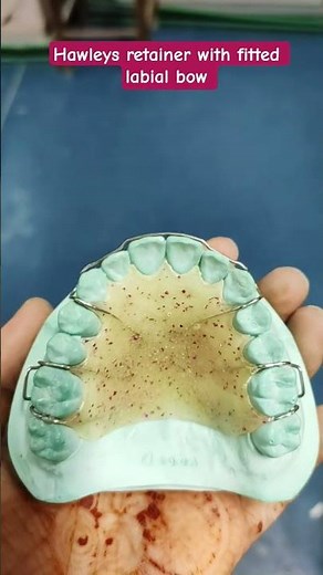 Hawley's retainer with fitted labial bow